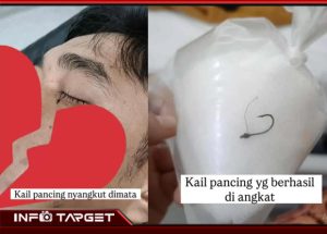 INSIDEN MENGERIKAN DI CIBINONG, MATA SALAH SATU WARGA TERTUSUK KAIL PANCING, HARUS MENJALANI OPERASI