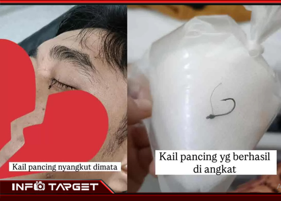 INSIDEN MENGERIKAN DI CIBINONG, MATA SALAH SATU WARGA TERTUSUK KAIL PANCING, HARUS MENJALANI OPERASI